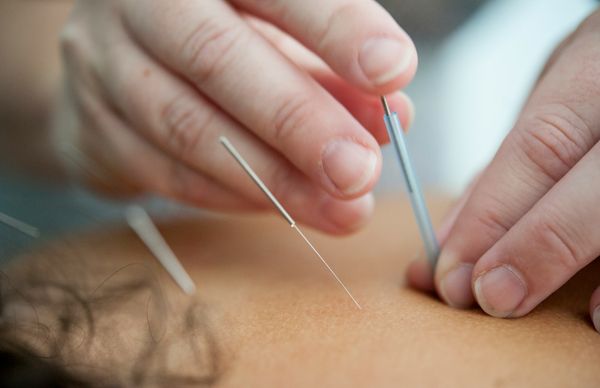 How Much Does Acupuncture Cost? 